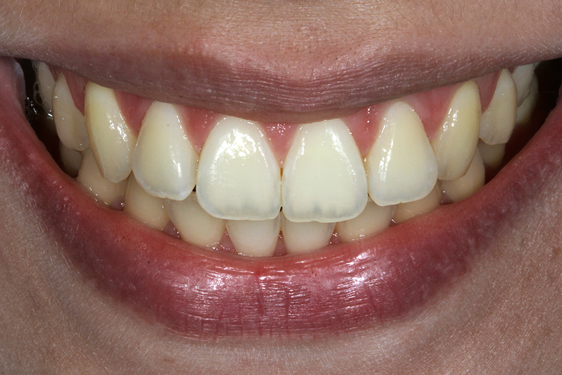 Sorriso com dentes escuros antes do clareamento