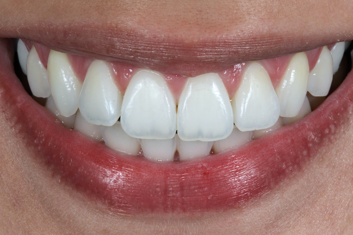 Sorriso com dentes claros após o clareamento dental